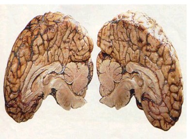 corpocalloso2